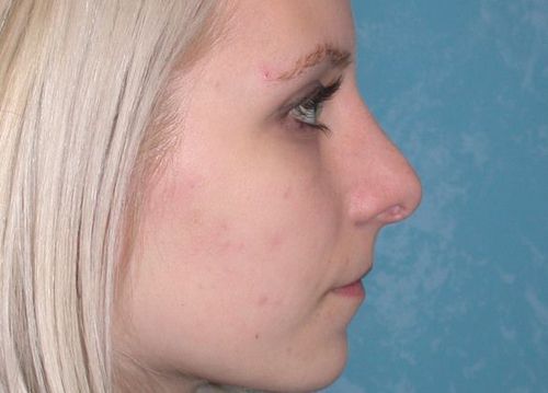 a woman's nose after rhinoplasty
