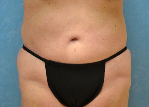 woman's midsection after tummy tuck
