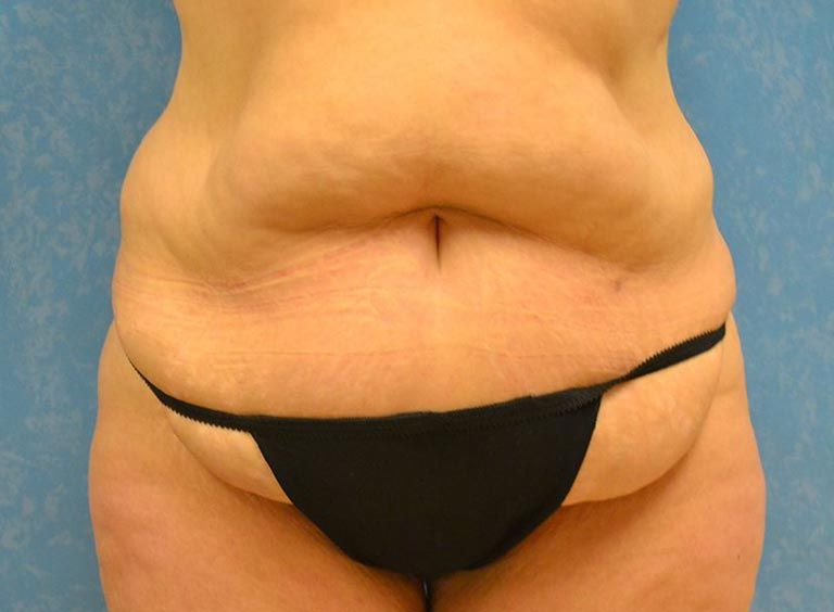 Before tummy tuck procedure