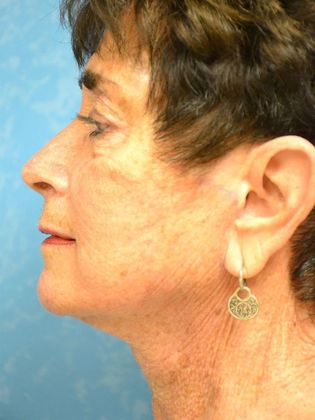 a female's face after facelift