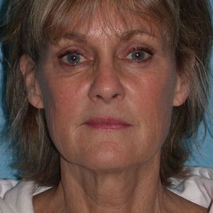 Patient before a facelift