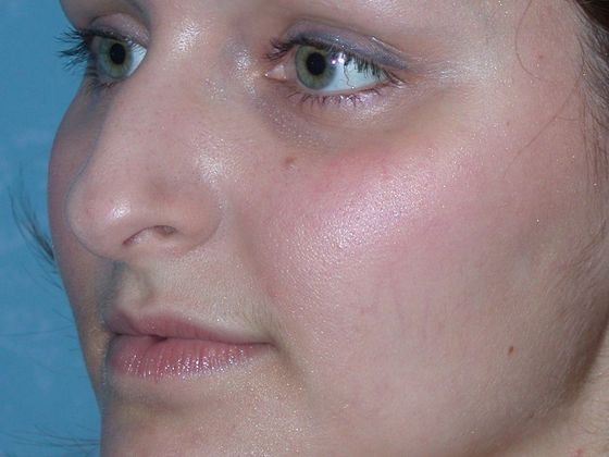 The patient's nose has a bump and the nostrils are unflattering.