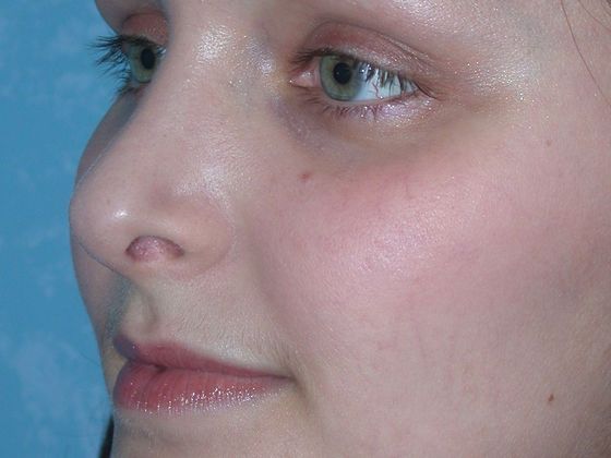 The patient has a straighter nose and resized nostrils after rhinoplasty.